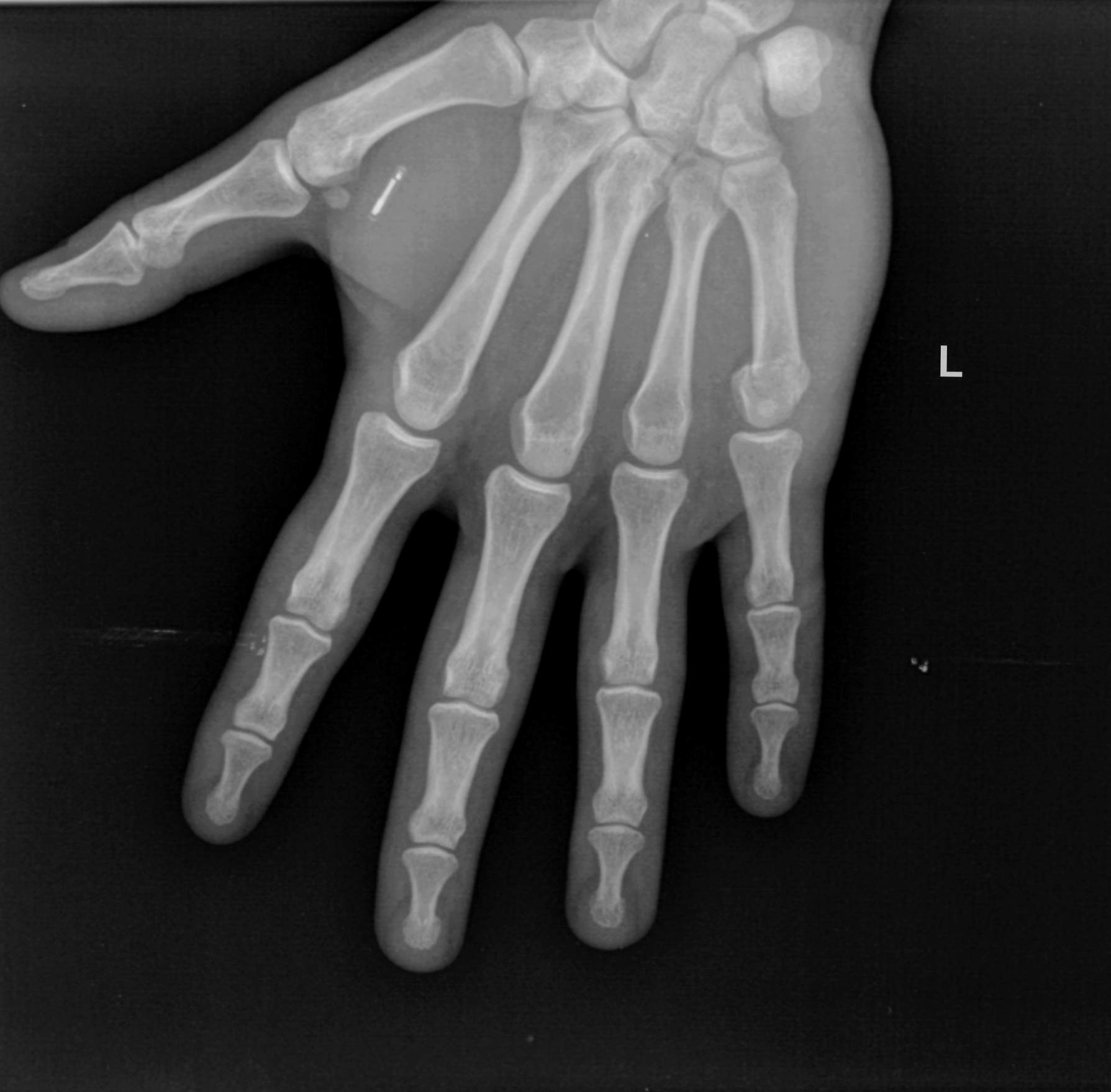 The Chip, in xray